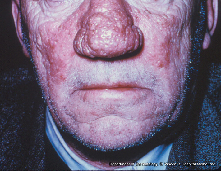 ACD A-Z of Skin - Rhinophyma