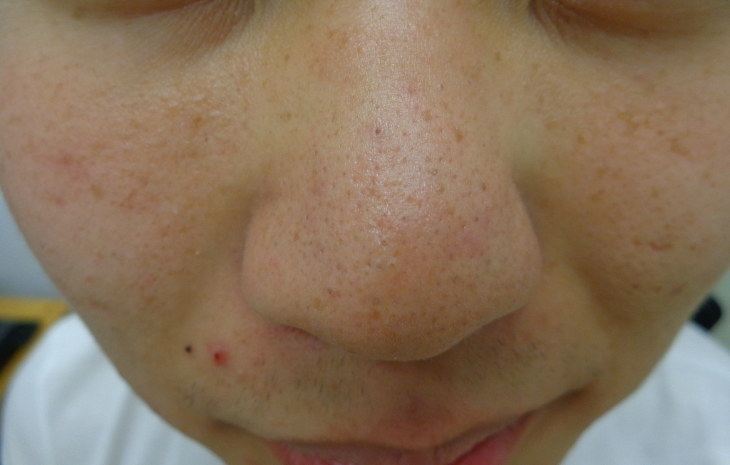 mild acne vulgaris