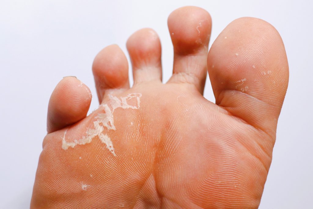 Athlete's Foot - Foot and Ankle Wellness Centre