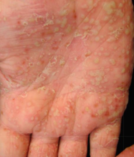 Acd A Z Of Skin Palmoplantar Pustulosis Ppp