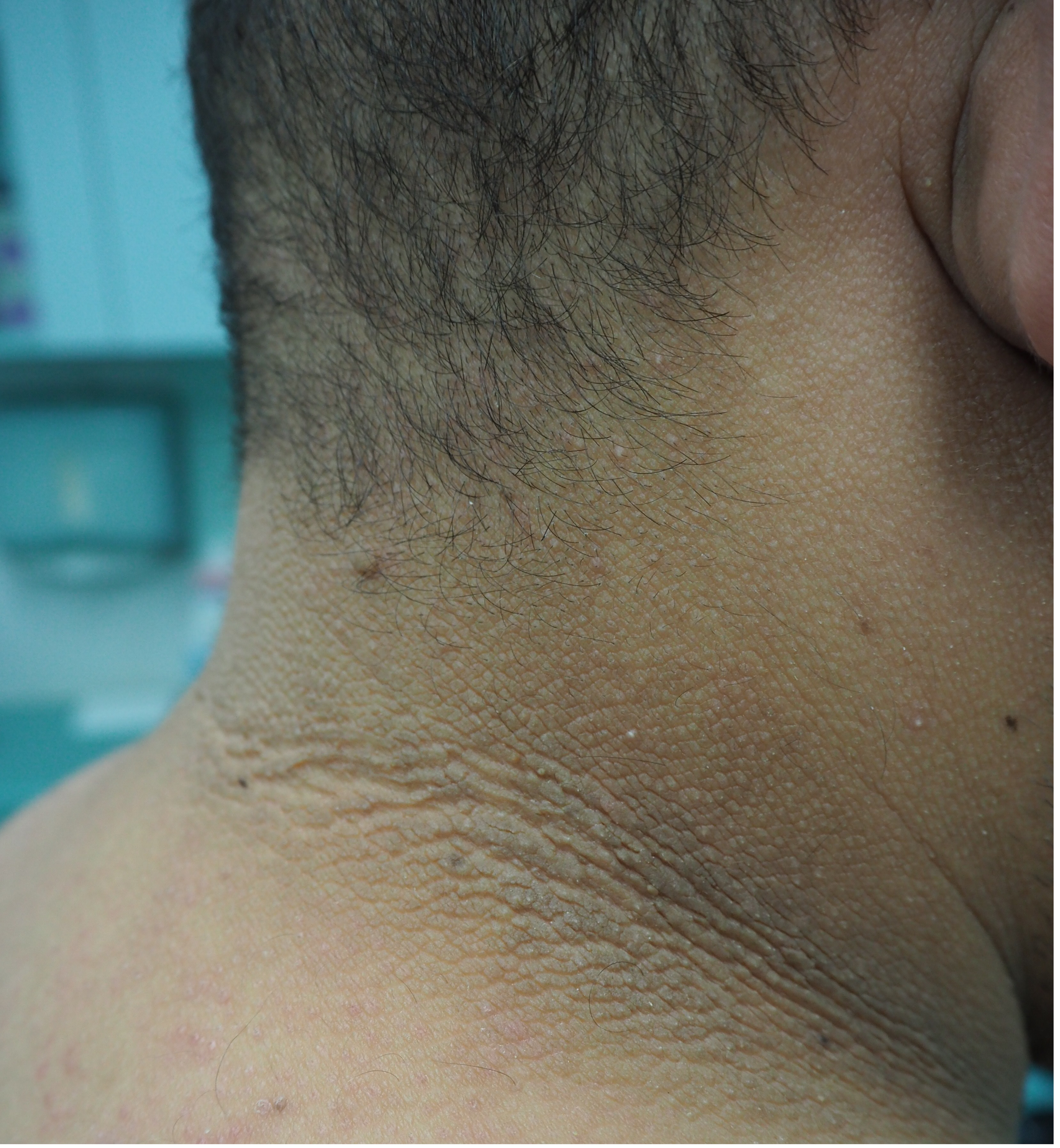 Nigricans treatment acanthosis