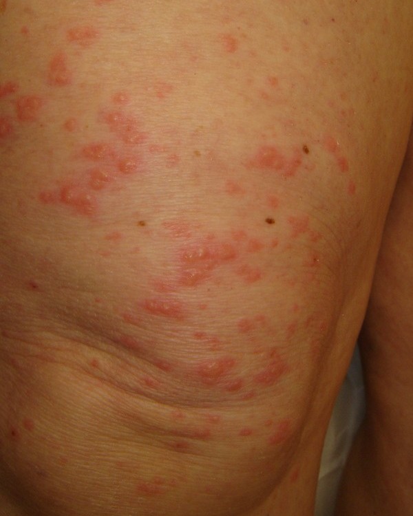 What is Scalp Dermatitis? (with pictures) - wiseGEEK