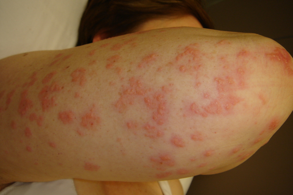 Dermatitis herpetiformis - Wikipedia