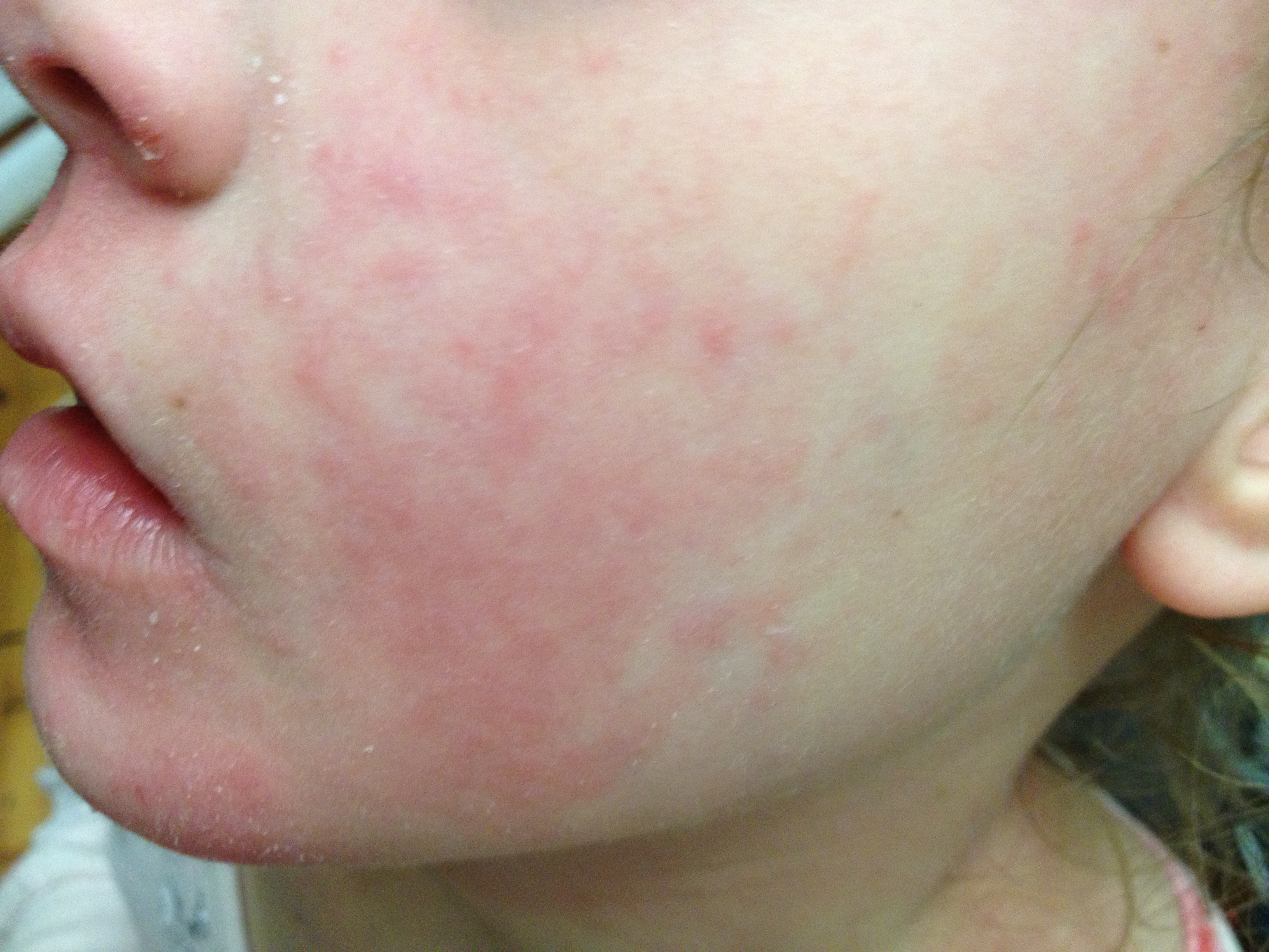 Acd A Z Of Skin Dermatitis Eczema