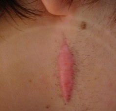 Keloid formation following excision of a pigmented lesion - image reproduced with permission of Dr Margaret Oziemski