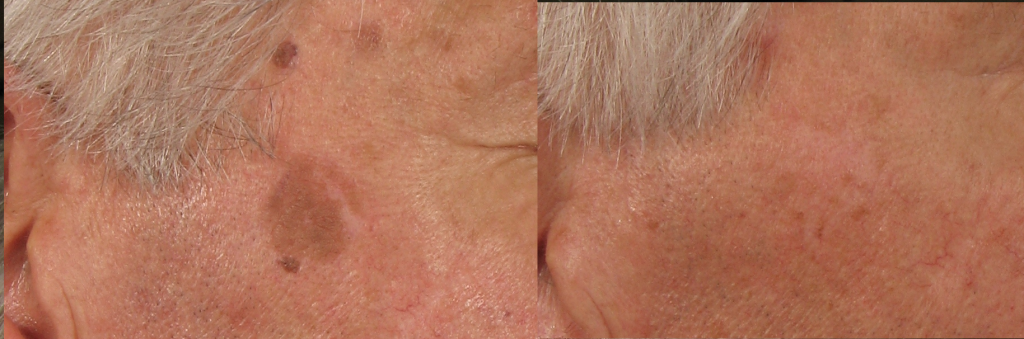 Acd A Z Of Skin Laser Treatment For Pigmentation