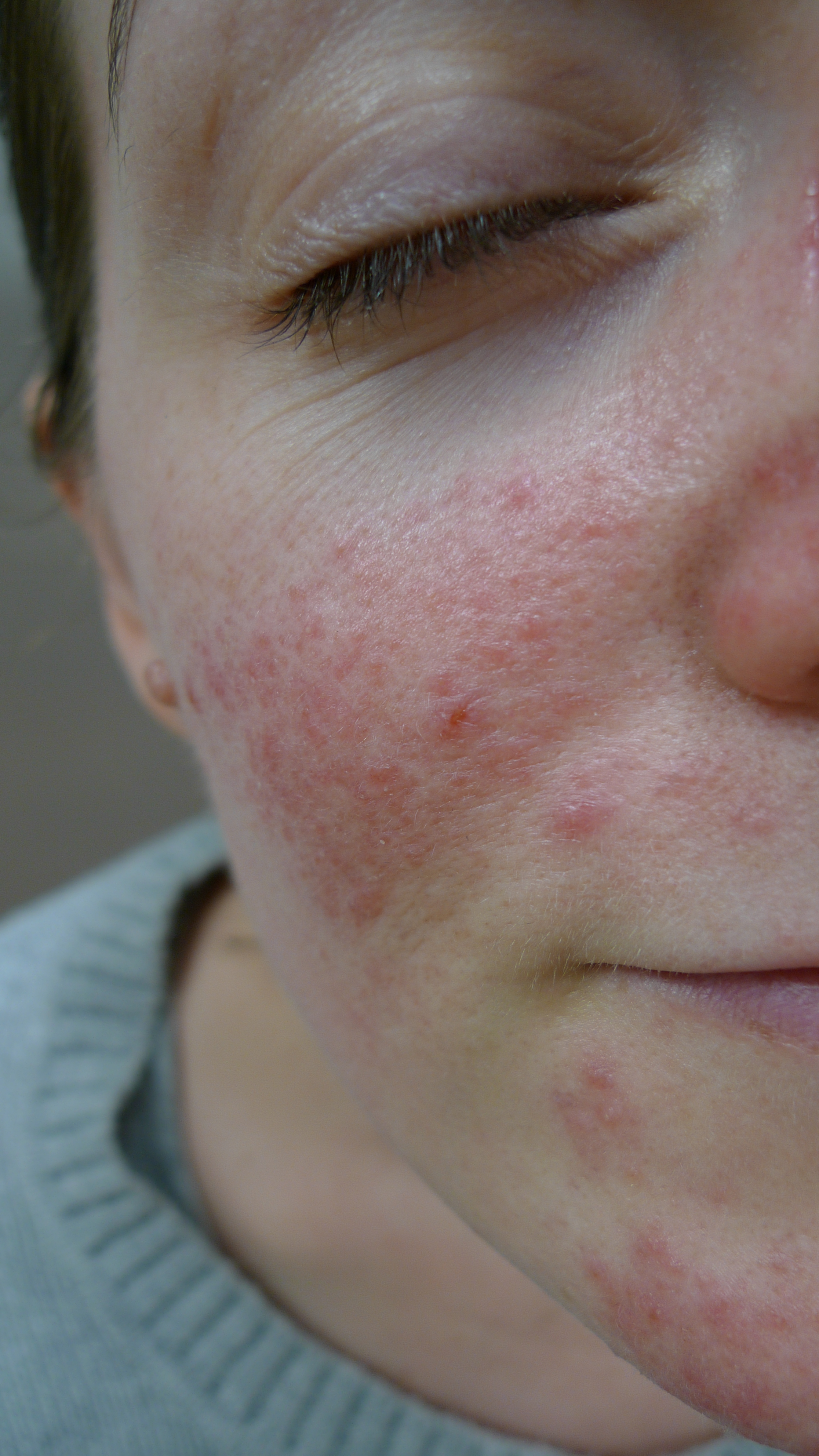 rosacea Image reproduced with permission of Dr Davin Lim