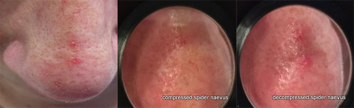 Spider naevus on the nose - images reproduced with permission of Dr Margaret Oziemski